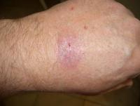 Wrist L - Worst1 - flash - 1-8-18.JPG