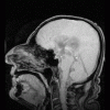 GAD/OCD/BipolarII - Advise regarding meds. Really really tired of experimenting. - last post by FocusPocus